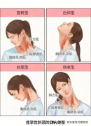 痉挛性斜颈恢复后如