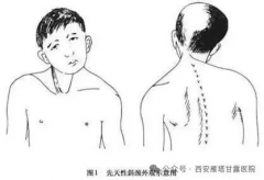 方向谈斜颈|想摆脱